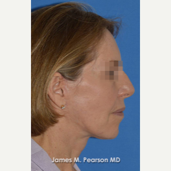 55-64 year old woman treated with Facelift after 3814872