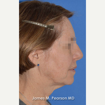 55-64 year old woman treated with Facelift before 3814872