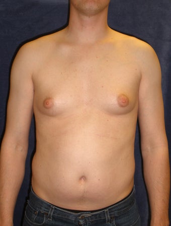 Male Breast Reduction before 407641