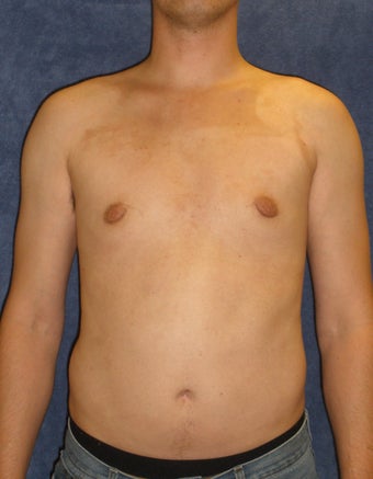 Male Breast Reduction after 407641