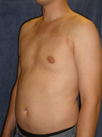 Male Breast Reduction 407641