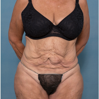 55-64 year old woman treated with Abdominoplasty and Ventral Hernia Repair before 3532543
