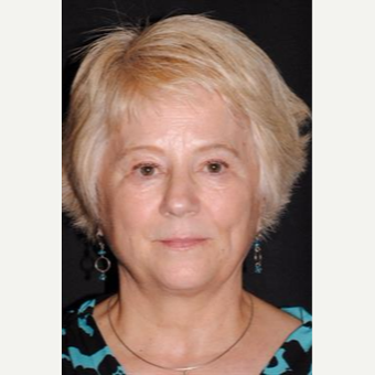 55-64 year old woman treated with Facelift before 3481208