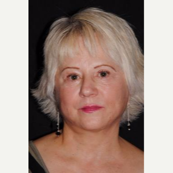 55-64 year old woman treated with Facelift after 3481208