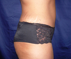 This patient is 36 years old 5'9" and 185 lbs. She chose a tummy tuck with liposuction. after 1412472