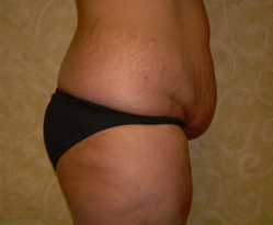 This patient is 36 years old 5'9" and 185 lbs. She chose a tummy tuck with liposuction. before 1412472