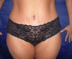 This patient is 36 years old 5'9" and 185 lbs. She chose a tummy tuck with liposuction. 1412472