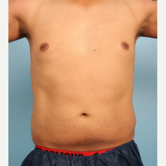 25-34 year old man treated with Abdominal Etching before 3339253
