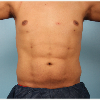 25-34 year old man treated with Abdominal Etching after 3339253