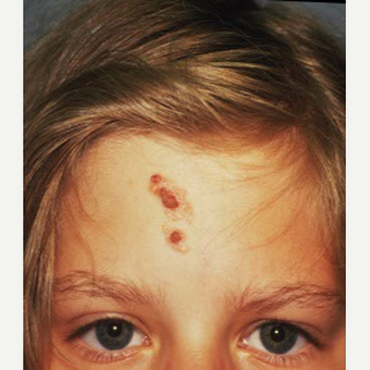 17 or under year old woman treated with Scar Removal before 3705041