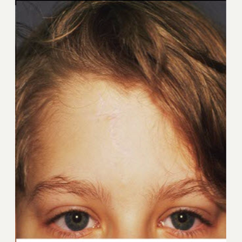 17 or under year old woman treated with Scar Removal after 3705041