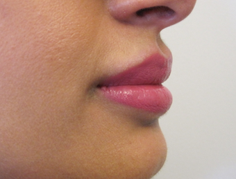 Lip Filler - Juvederm Volbella after 1305540