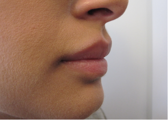 Lip Filler - Juvederm Volbella before 1305540