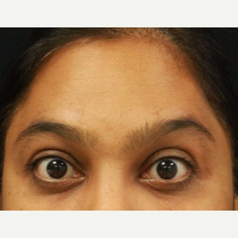 38 year old female treated with Botox for forehead wrinkles after 3072478