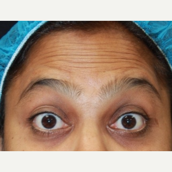 38 year old female treated with Botox for forehead wrinkles before 3072478