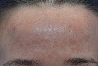 25-34 year old woman treated with Fractional Laser before 3141122