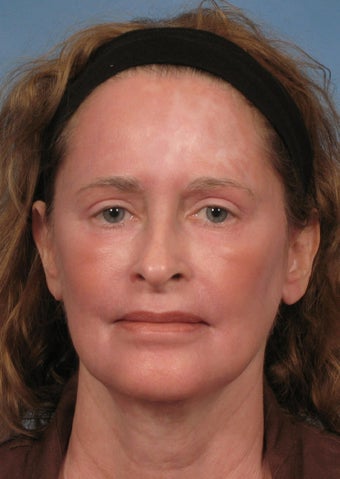 51 year old woman with sun damage treated with a Croton Oil/Phenol Peel after 1194032