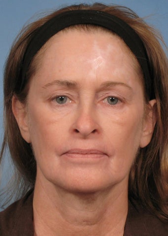 51 year old woman with sun damage treated with a Croton Oil/Phenol Peel before 1194032