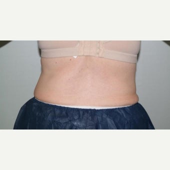 55-64 year old woman treated with CoolSculpting using the cool curve+ to her bilateral flanks. after 2184859
