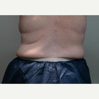 55-64 year old woman treated with CoolSculpting using the cool curve+ to her bilateral flanks. before 2184859