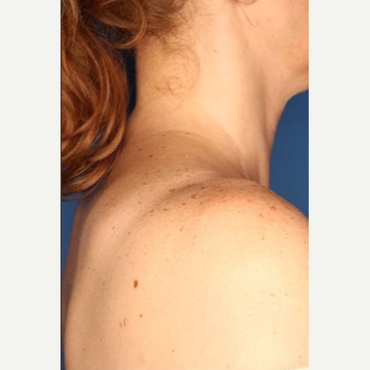 35-44 year old woman treated with IPL before 3715156