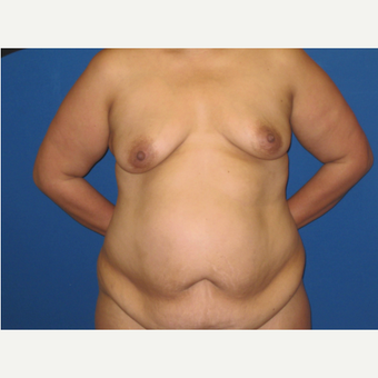 35-44 year old woman treated with Mommy Makeover: 24 hour recovery breast augmentation and TT before 3005444