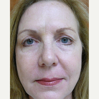 45-54 year old woman treated with Active FX after 3710337