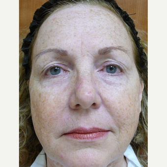 45-54 year old woman treated with Active FX before 3710337