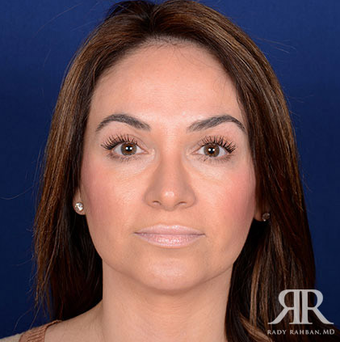 Rhinoplasty after 1315585