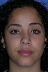 A 29 year old female underwent a closed revision rhinoplasty with a dorsal reduction, septoplasty, dome binding sutures to narro before 1240430