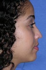 A 29 year old female underwent a closed revision rhinoplasty with a dorsal reduction, septoplasty, dome binding sutures to narro 1240430