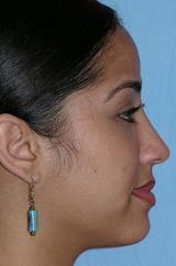 A 29 year old female underwent a closed revision rhinoplasty with a dorsal reduction, septoplasty, dome binding sutures to narro 1240430