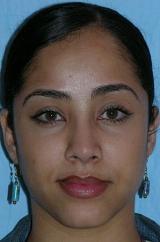 A 29 year old female underwent a closed revision rhinoplasty with a dorsal reduction, septoplasty, dome binding sutures to narro after 1240430