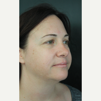 35-44 year old woman treated with Facelift before 3405580
