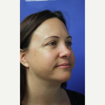35-44 year old woman treated with Facelift after 3405580