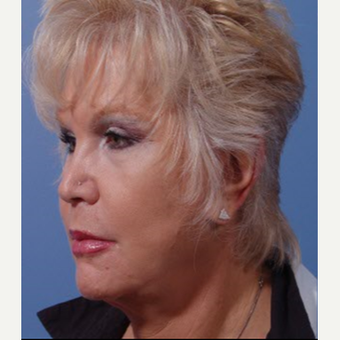 55-64 year old woman treated with Cheek Lift before 3710264