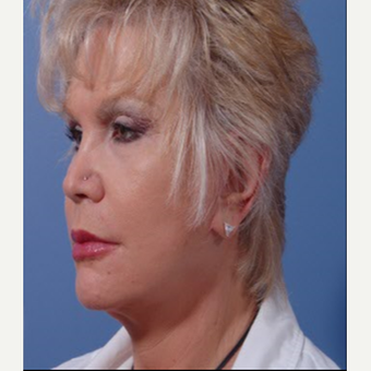 55-64 year old woman treated with Cheek Lift after 3710264
