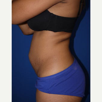 Tummy Tuck before 3743914
