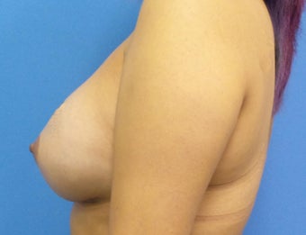 35-44 year old woman treated with Breast Augmentation 3849695