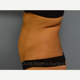 45-54 year old woman treated with Liposuction before 3367932