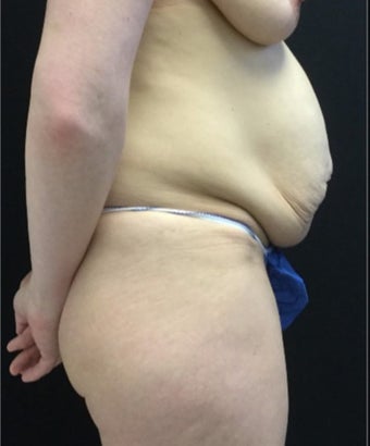 35-44 year old woman treated with Tummy Tuck before 3219230