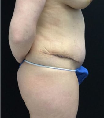 35-44 year old woman treated with Tummy Tuck after 3219230