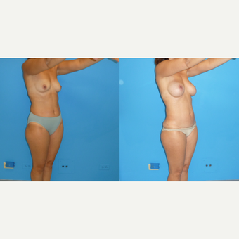 45-54 year old woman treated with Mommy Makeover after 3564418