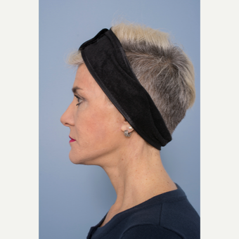 55-64 year old woman treated with Facelift after 3329018