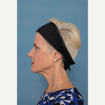 55-64 year old woman treated with Facelift before 3329018