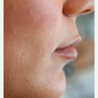 Natural Lip Augmentation before 3292782