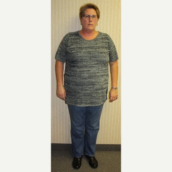 48 year old woman treated with Sleeve Gastrectomy before 2043042