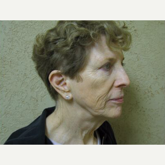 Facelift before 3454837