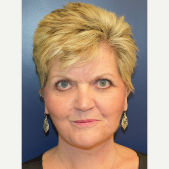 55-64 year old woman treated with Lower Face Lift after 3188117