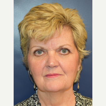 55-64 year old woman treated with Lower Face Lift before 3188117